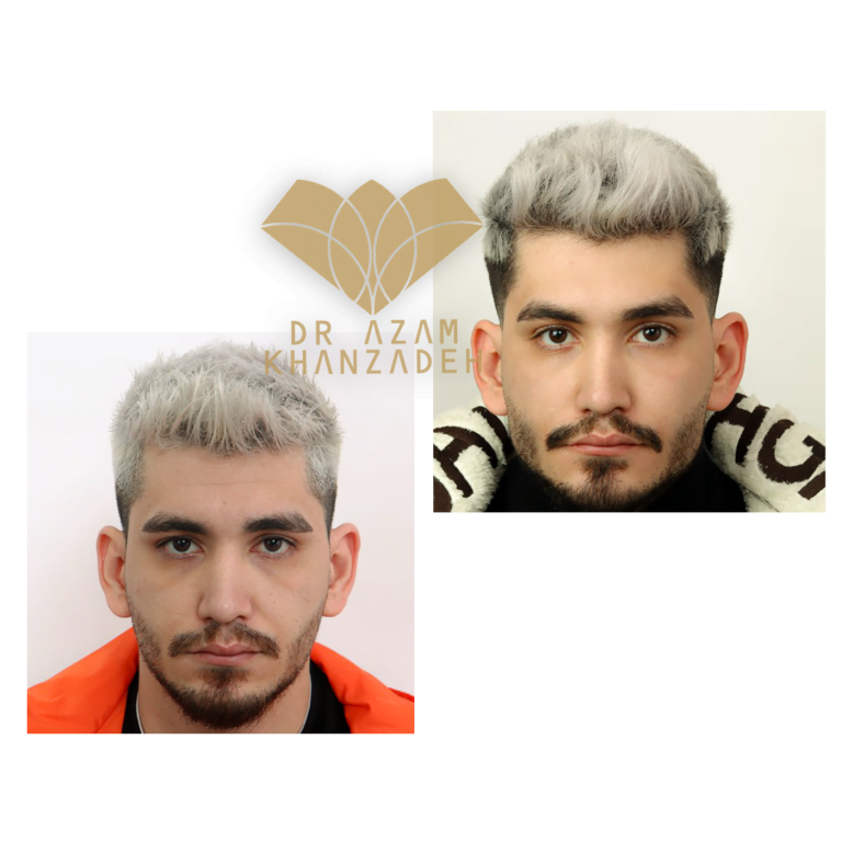 زاویه سازی صورت