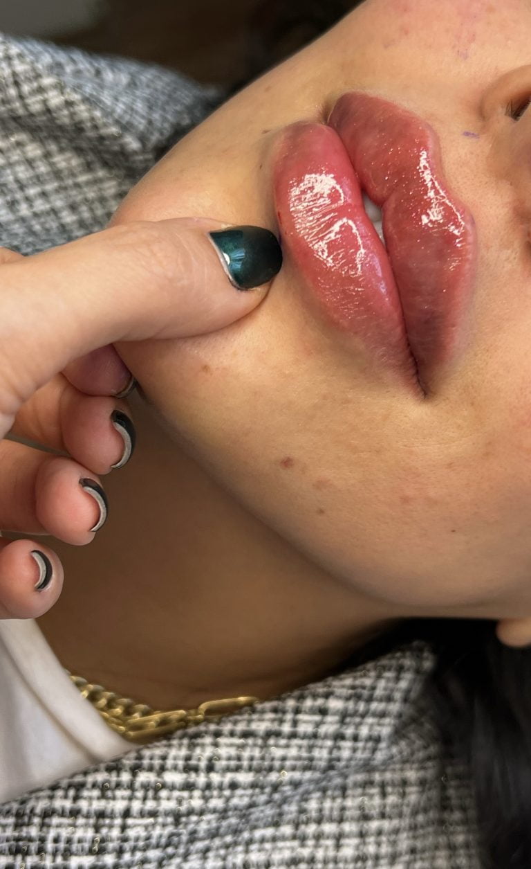 تزریق ژل لب