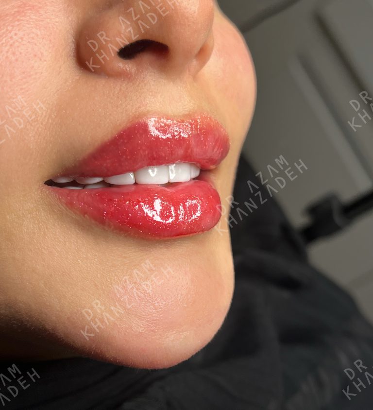 تزریق ژل لب