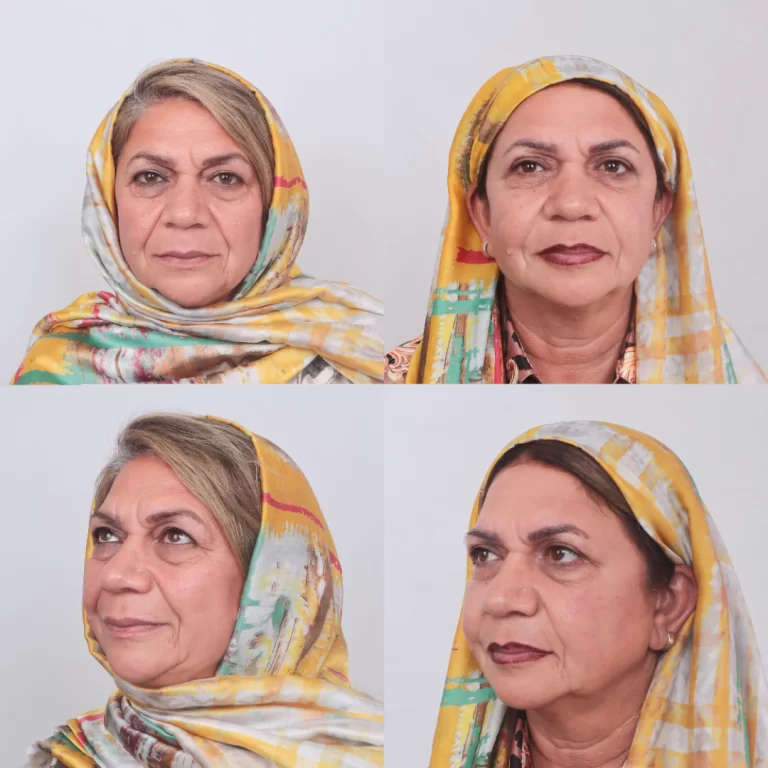فیلر چشم