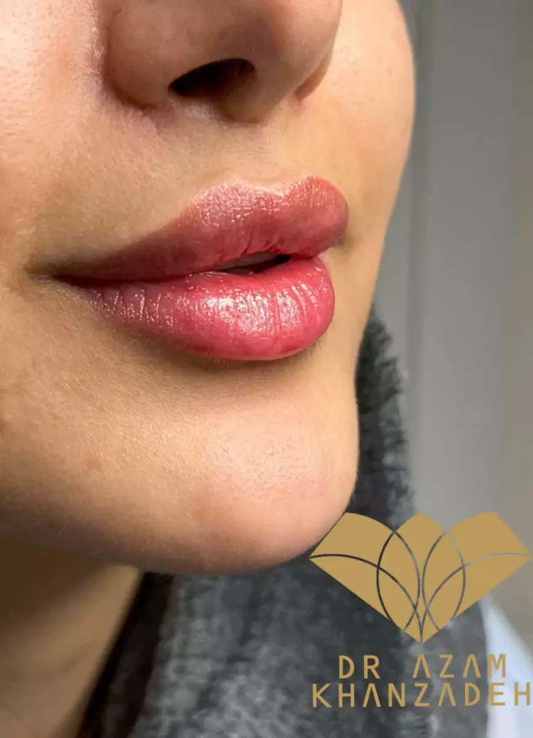 مقدار مناسب تزریق ژل لب