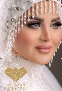 کبودی پس از تزریق ژل لب