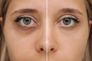 tear trough filler transformation