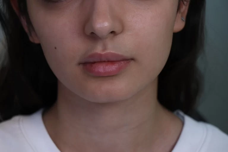 فیلر چانه