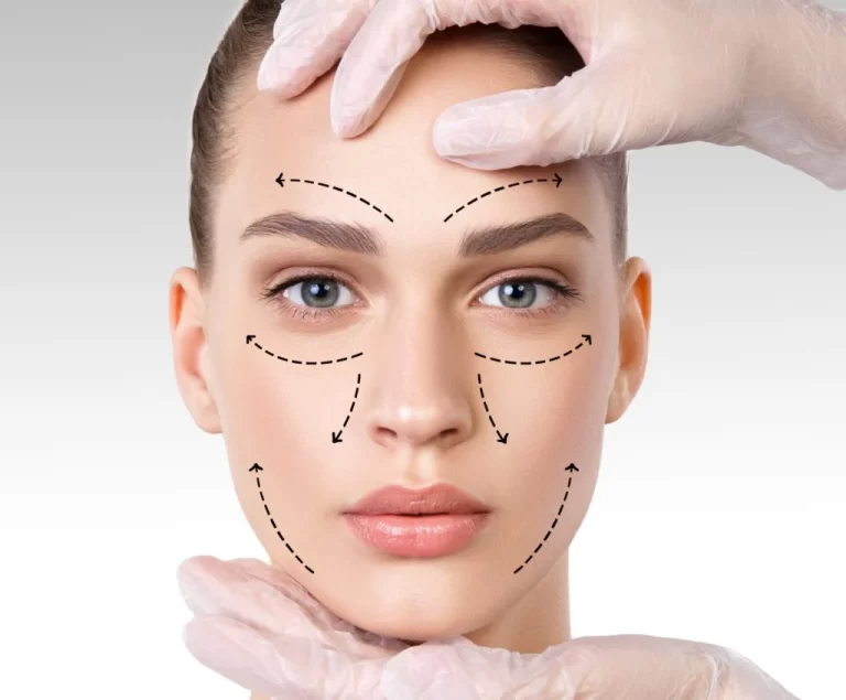 Thread Lift