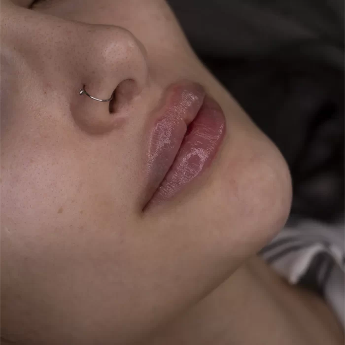 تزریق ژل لب در مشهد