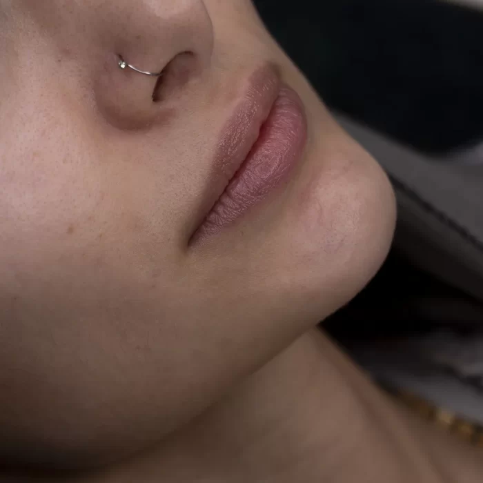 تزریق ژل لب در مشهد