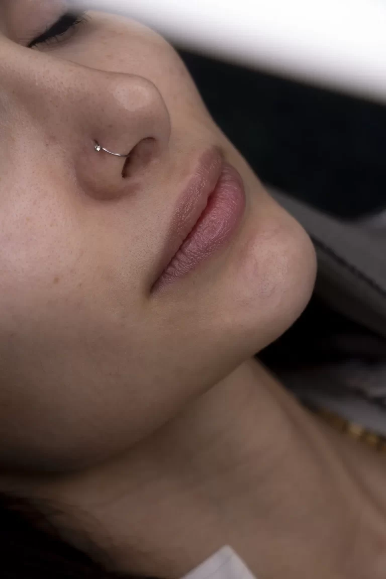 تزریق ژل لب در مشهد
