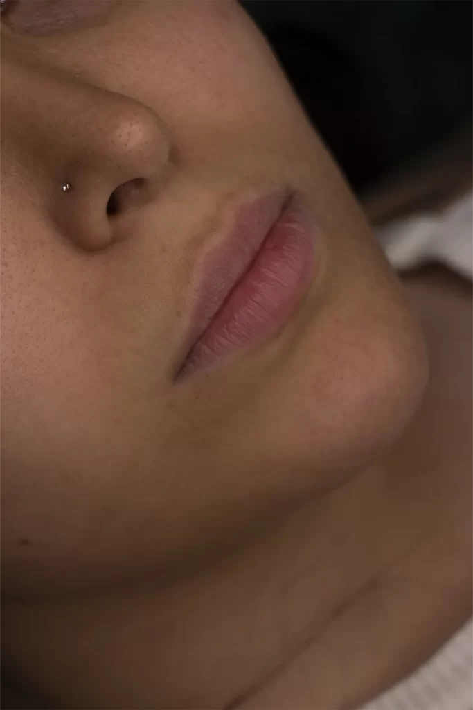 تزریق ژل لب در مشهد
