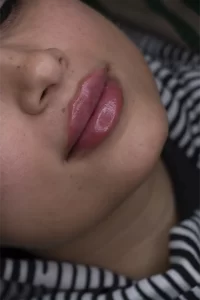 تزریق ژل لب در مشهد