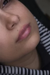 تزریق ژل لب در مشهد