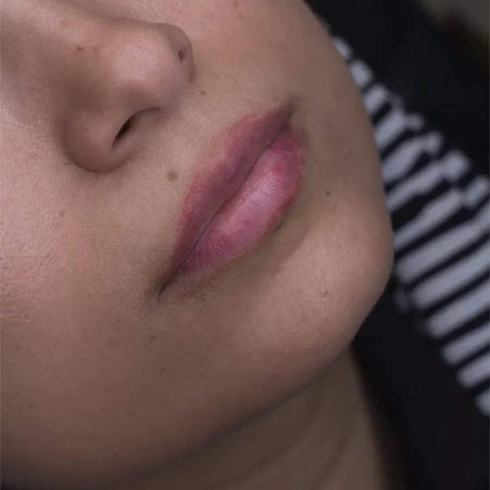 تزریق ژل لب در مشهد