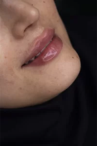 تزریق ژل لب در مشهد
