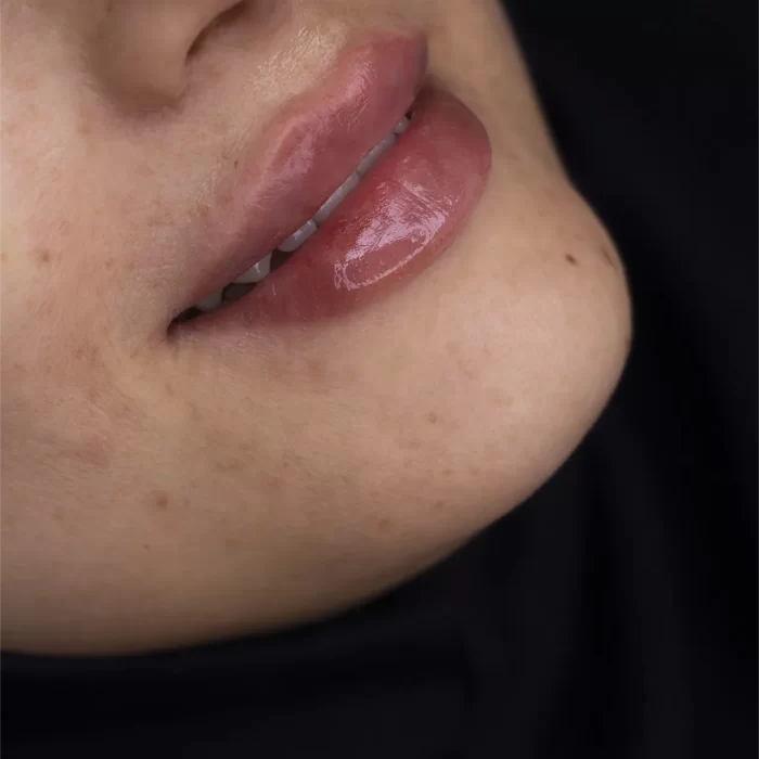 تزریق ژل لب در مشهد