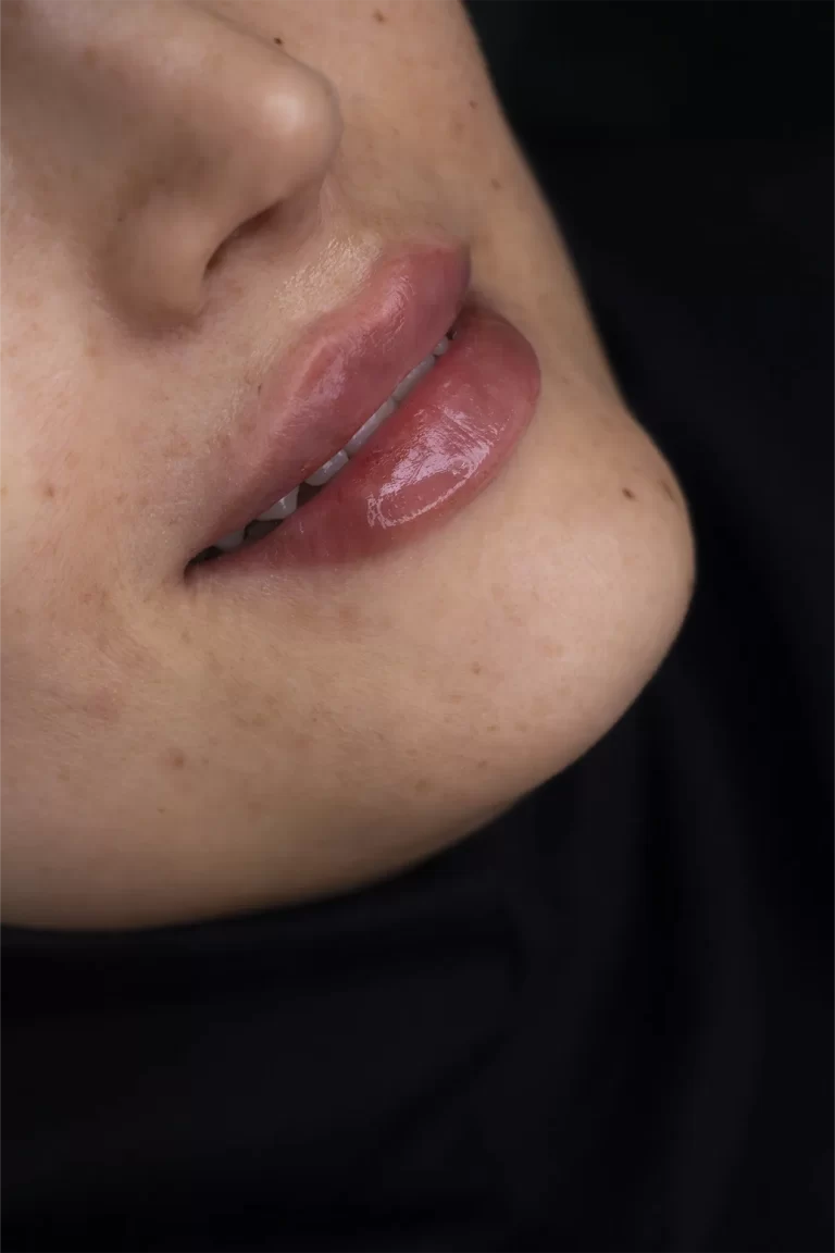 تزریق ژل لب در مشهد