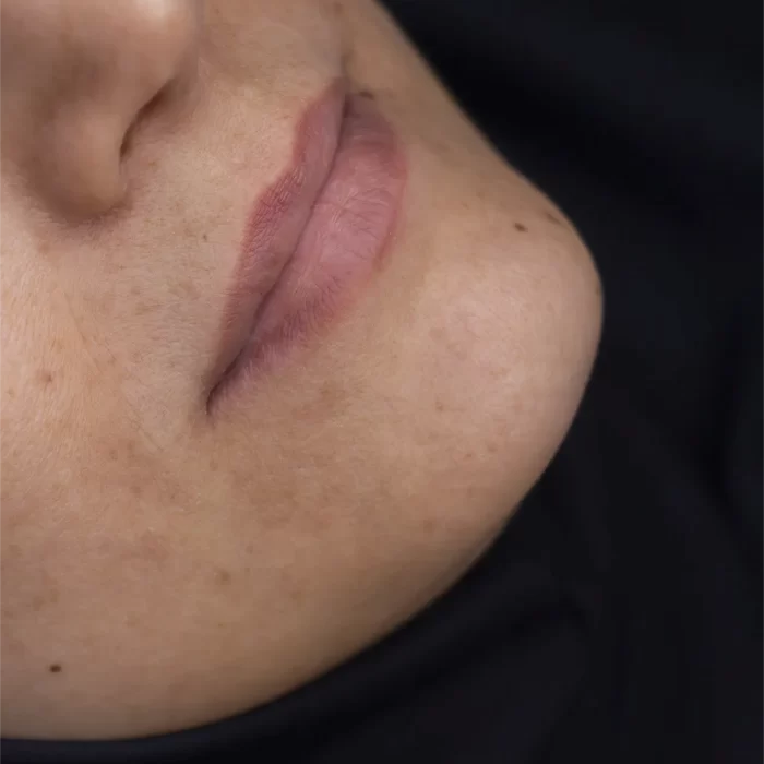 تزریق ژل لب در مشهد