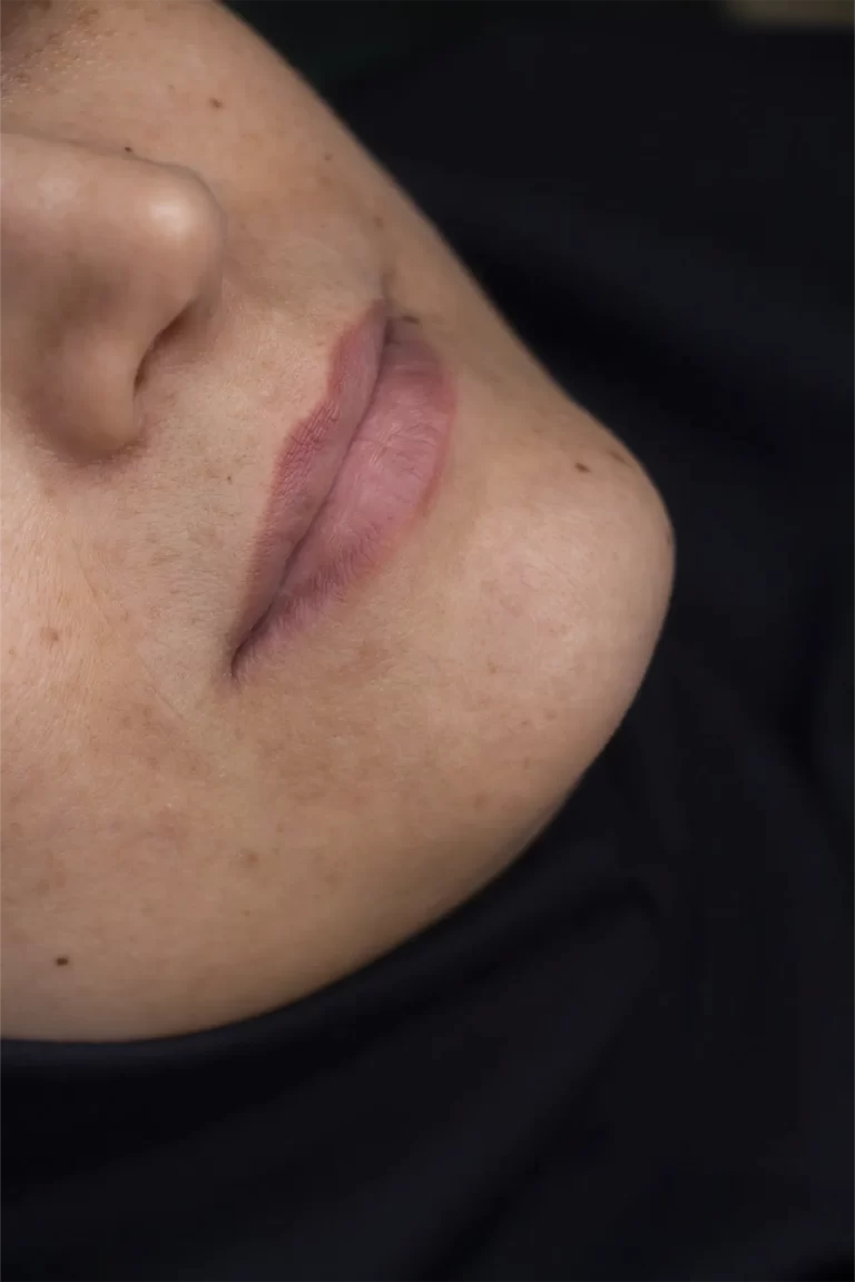 تزریق ژل لب در مشهد
