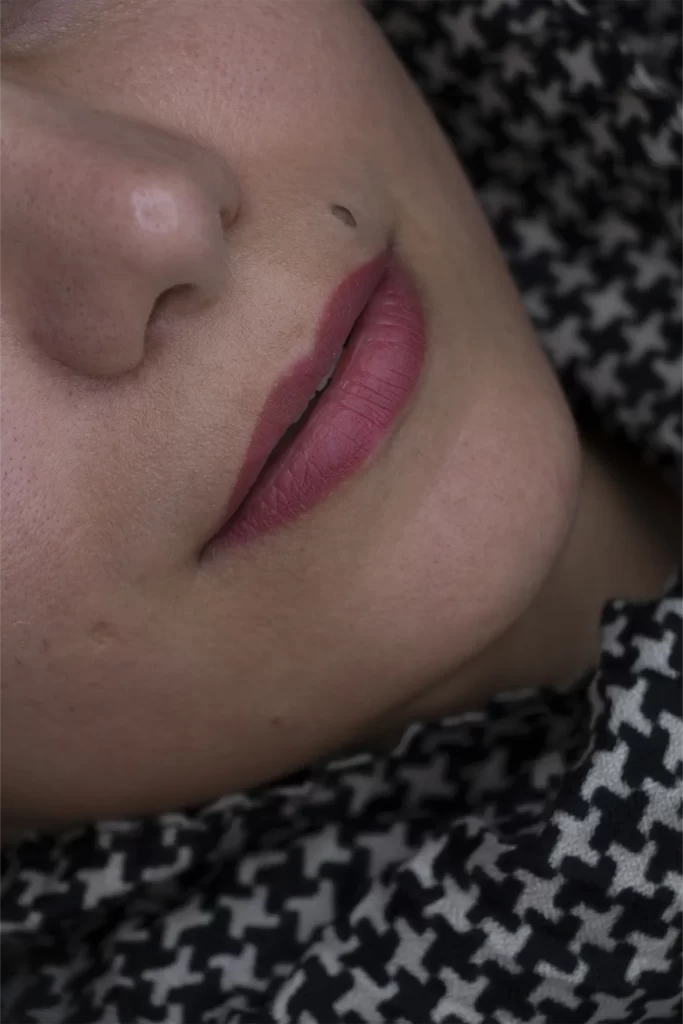 تزریق ژل لب در مشهد