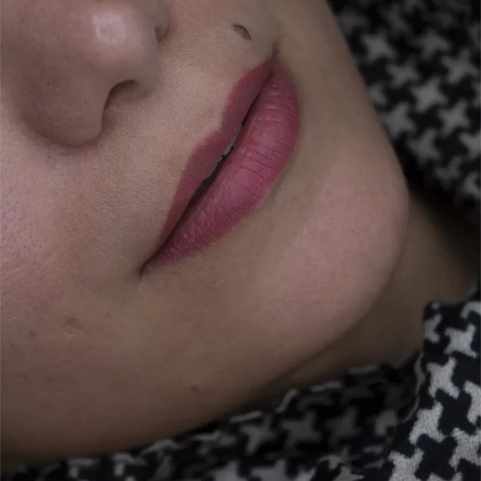 تزریق ژل لب در مشهد