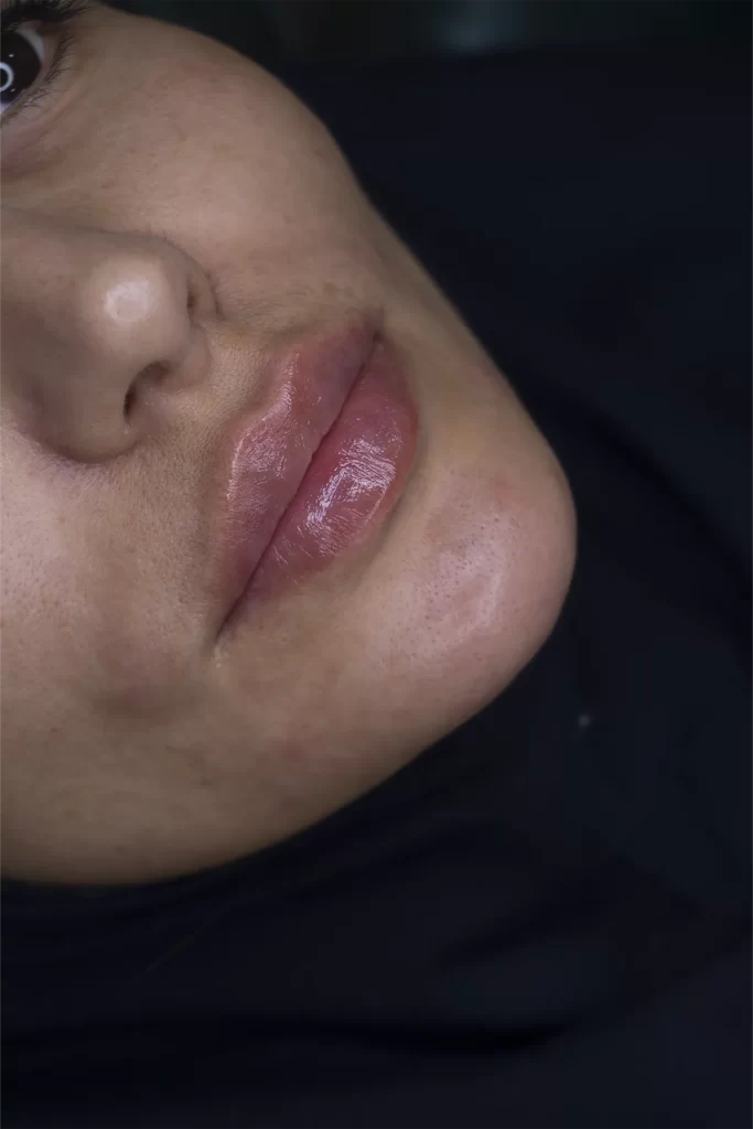 تزریق ژل لب در مشهد