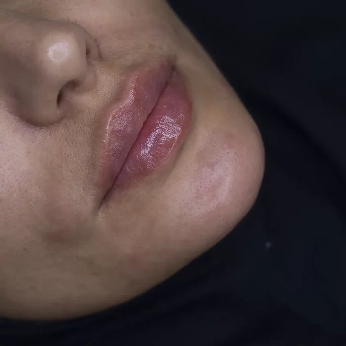 تزریق ژل لب در مشهد