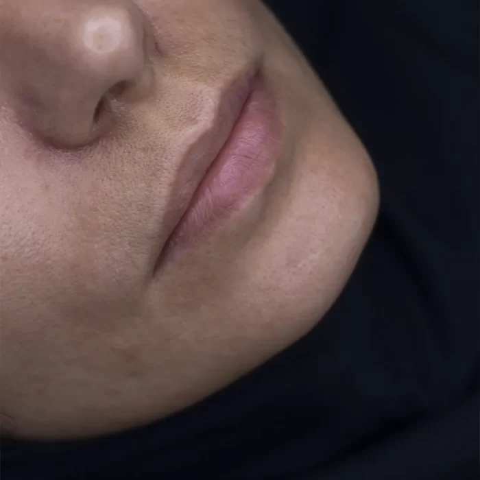 تزریق فیلر
