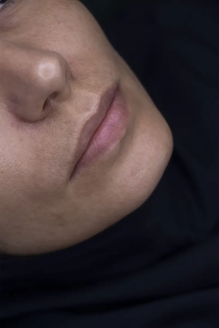 تزریق فیلر