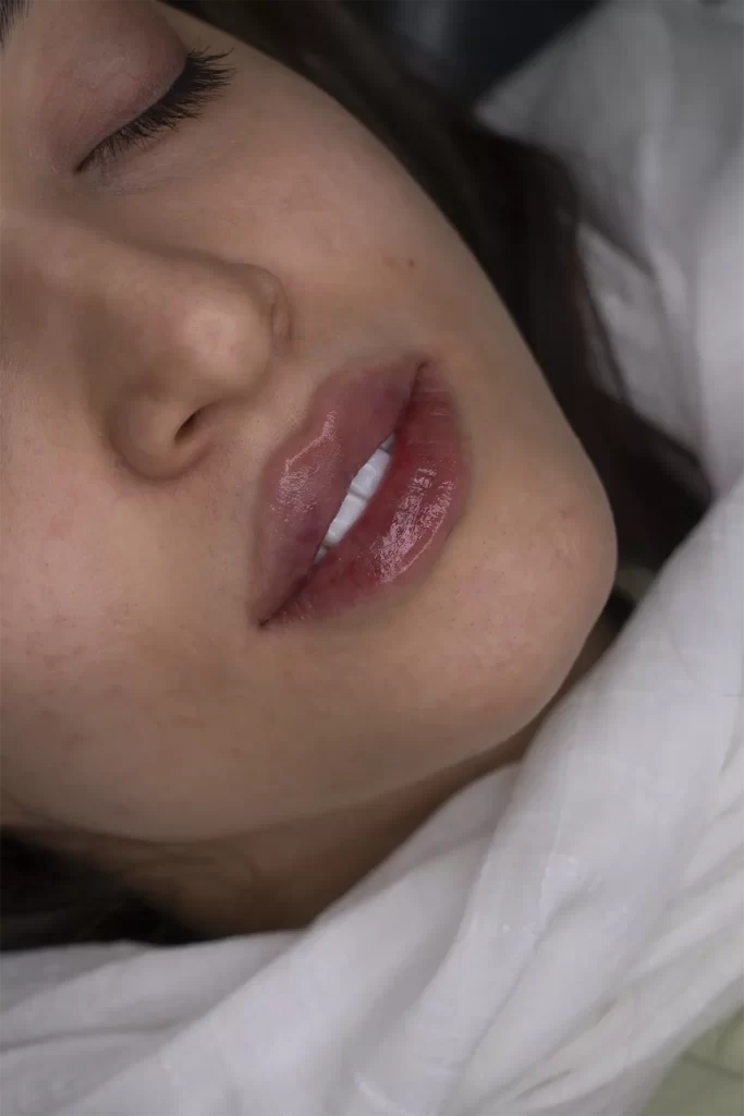 تزریق ژل لب در مشهد