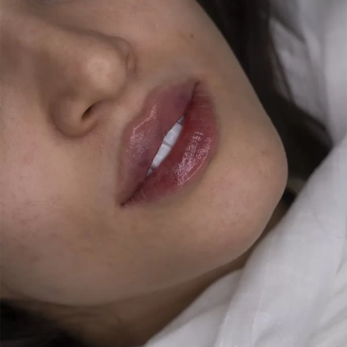 تزریق ژل لب در مشهد