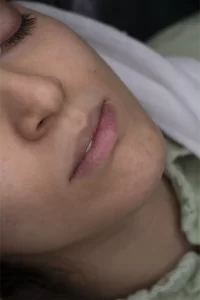 تزریق ژل لب در مشهد