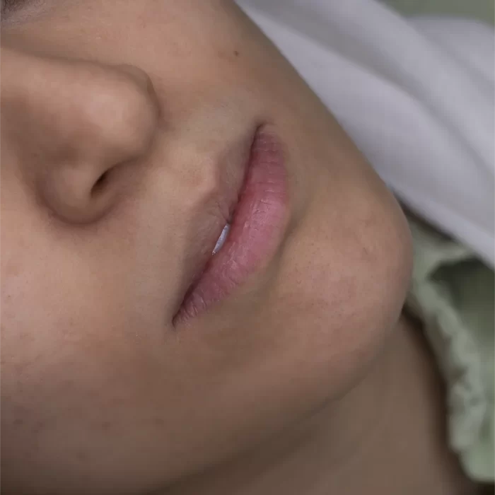 تزریق ژل لب در مشهد