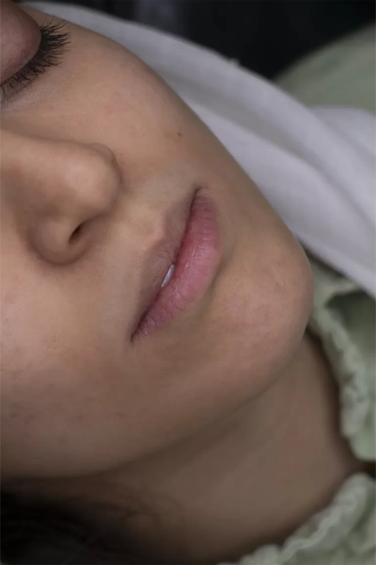 تزریق ژل لب در مشهد