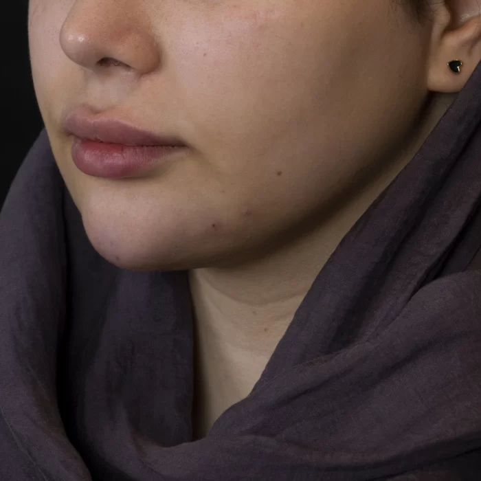 فیلر چانه