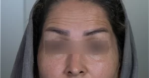 بوتاکس صورت و گردن