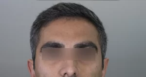 بوتاکس صورت و گردن