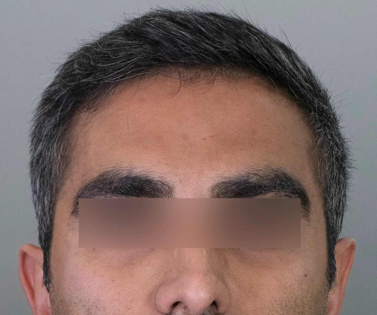 بوتاکس در مشهد
