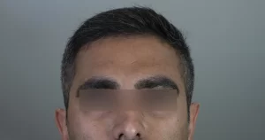 بوتاکس صورت و گردن