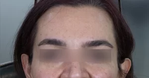 بوتاکس تخصصی برای پوستی صاف و شاداب
