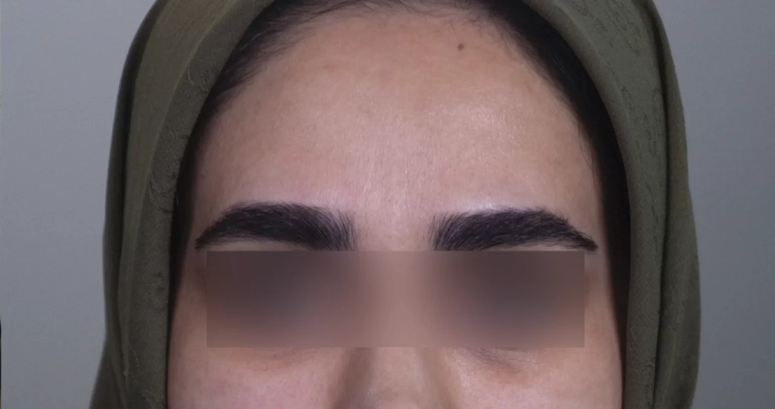 تزریق بوتاکس در مشهد برای جوانسازی پوست صورت