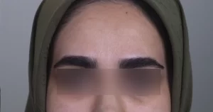 تزریق بوتاکس در مشهد برای جوانسازی پوست صورت
