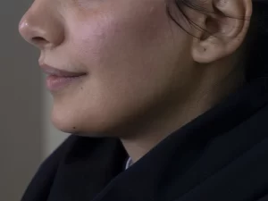 بعد از انجام کانتورینگ نچرال دکتر خانزاده تغییر زیادی ایجاد شده است