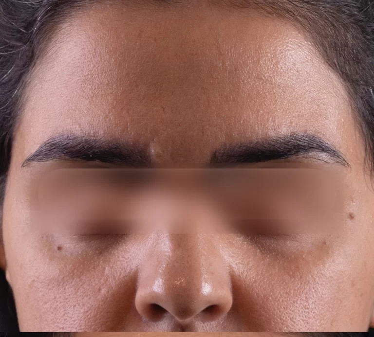 تزریق فیلر چشم