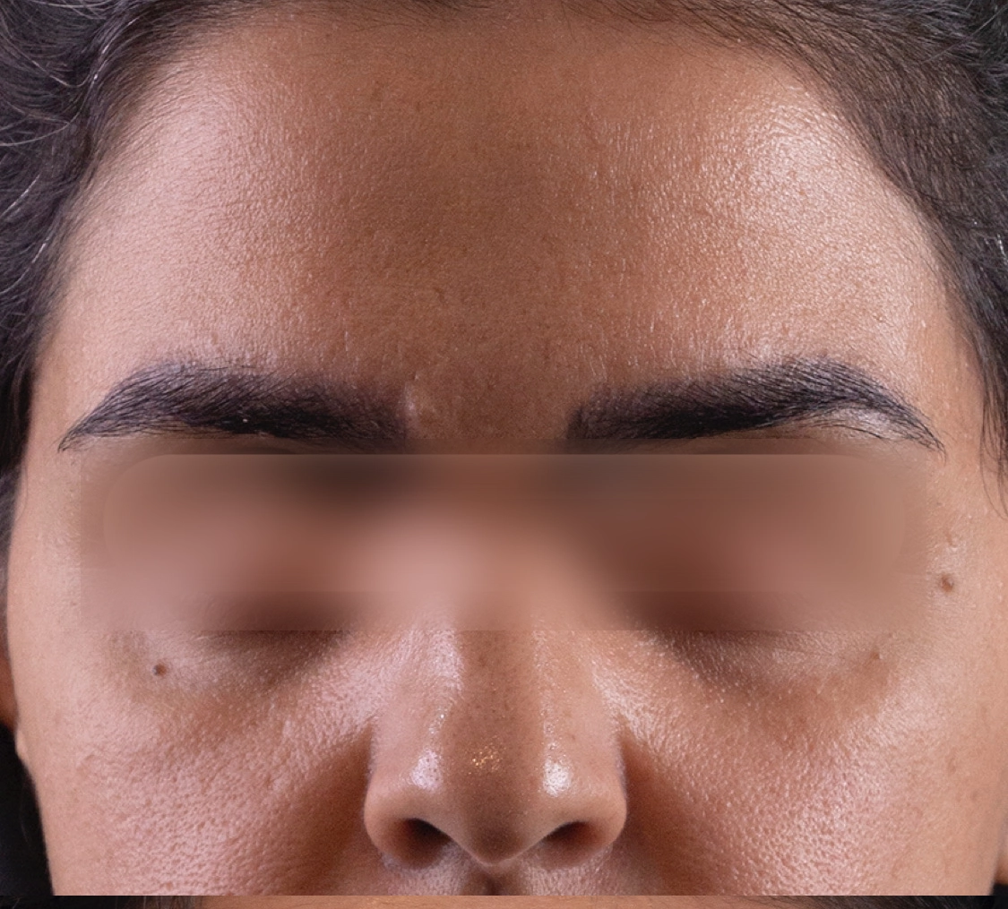 تزریق فیلر چشم