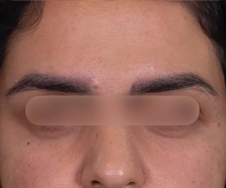تزریق فیلر چشم