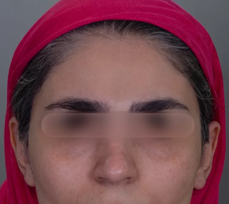 بهترین فیلر زیر چشم