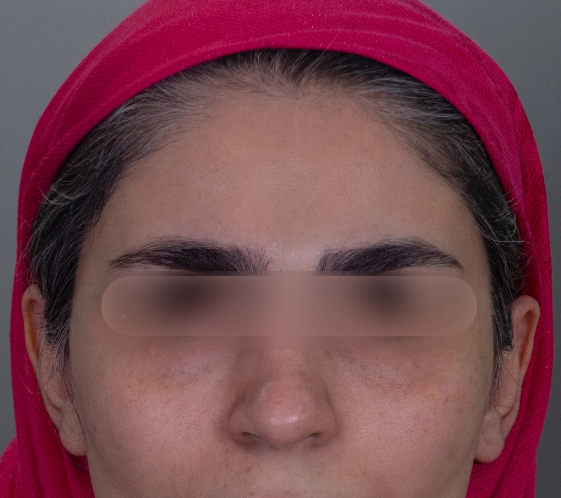 بهترین فیلر زیر چشم