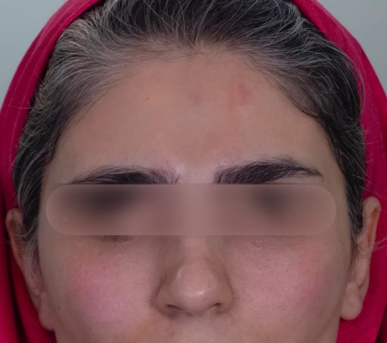 بهترین فیلر زیر چشم