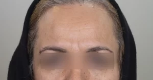 بهترین دکتر تزریق بوتاکس در مشهد – دکتر خانزاده