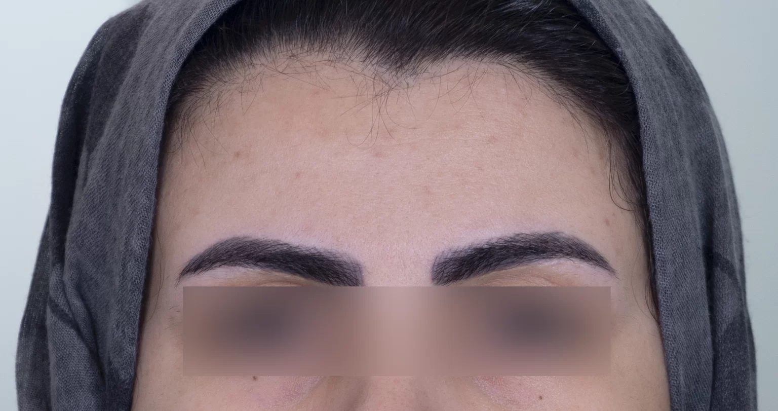 ل بوتاکس در مشهد برای جوانسازی پوست صورت