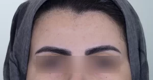 ل بوتاکس در مشهد برای جوانسازی پوست صورت